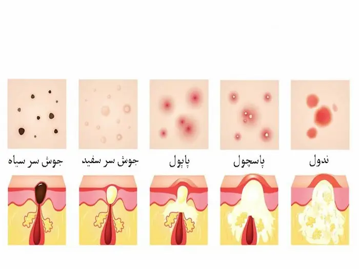 انواع جوش روی بدن و صورت 8353948453