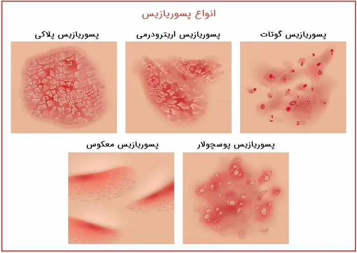 انواع پسوریازیس 9475943534