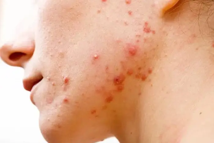 جوش زدن بعد از اصلاح 3478394324