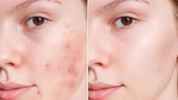 قبل و بعد از داشتن روتین پوستی و از بین رفتن جوش های صورت 54565644
