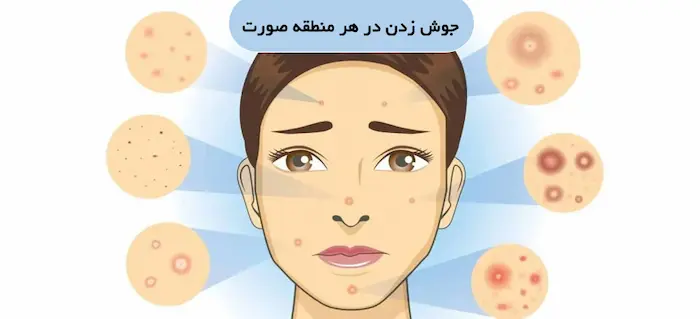 نمونه انواع جوش های پوست در هر قسمت صورت 32456452502