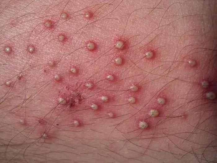 بیمار مبتلا به فولیکولیت شدید 8503453454