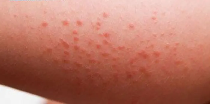 جوش روی باسن و التهاب آن روی پوست 9576495