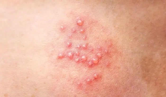 جوش روی باسن و ملتهب شدن پوست 95764496745