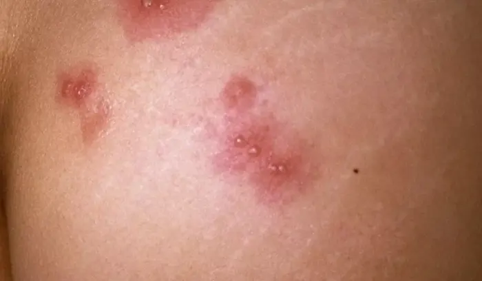 جوش روی باسن و ملتهب شدن پوست 9576495