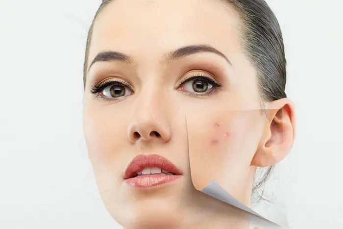 جوش روی پوست خانم و راز داشتن پوست سالم و بدون جوش در بهار 945743345