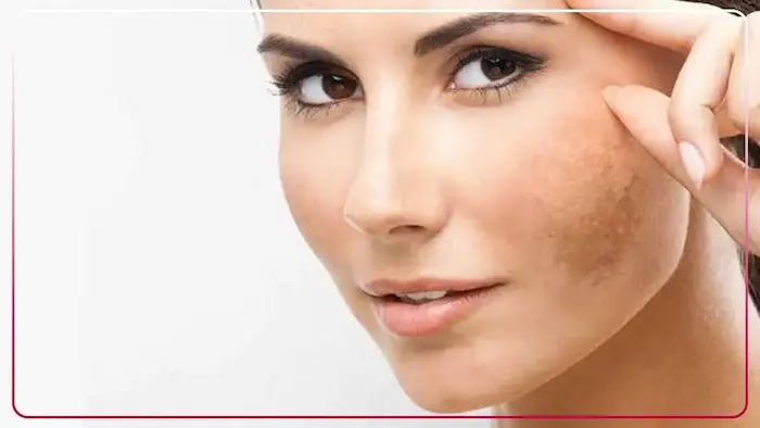خانم مبتلا به لک پوستی 8459645654