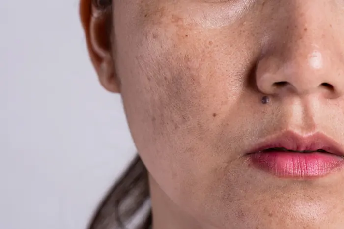 خانم مبتلا به لک پوستی روی گونه 8459645654