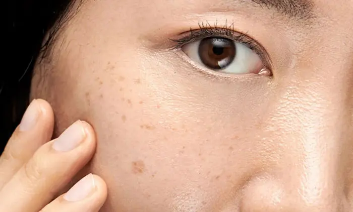 خانم مبتلا به لک پوستی روی گونه 845965654