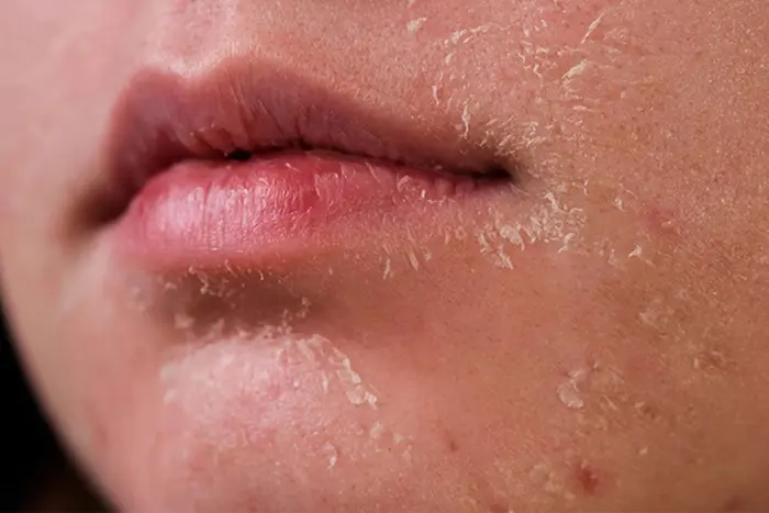 خشکی و پوسته پوسته شدن پوست اطراف دهان 65456475641
