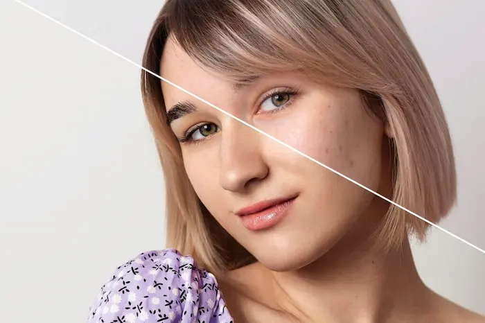 پوست خشک و دارای آکنه 54754654210