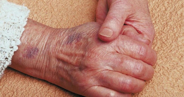 علائم خشکی پوست یک فرد سالمند 65656