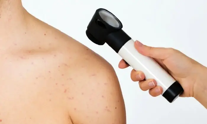 بررسی جوش های بدن در کلینیک 5644654120