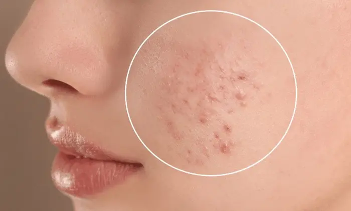 جوش های صورت به دلیل استفاده از لوسیون نامناسب 545645120