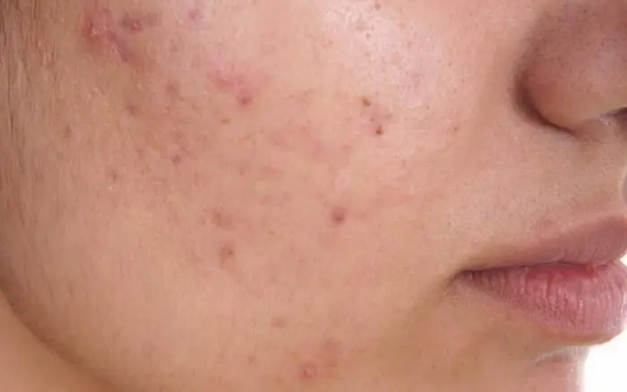 افزایش آکنه روی پوست 6546545610