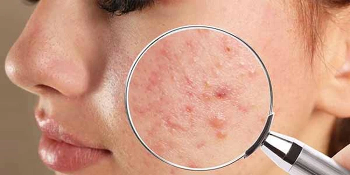 کاهش آکنه های پوستی بعد از روتین پوست‌ آکنه‌ دار 6546412