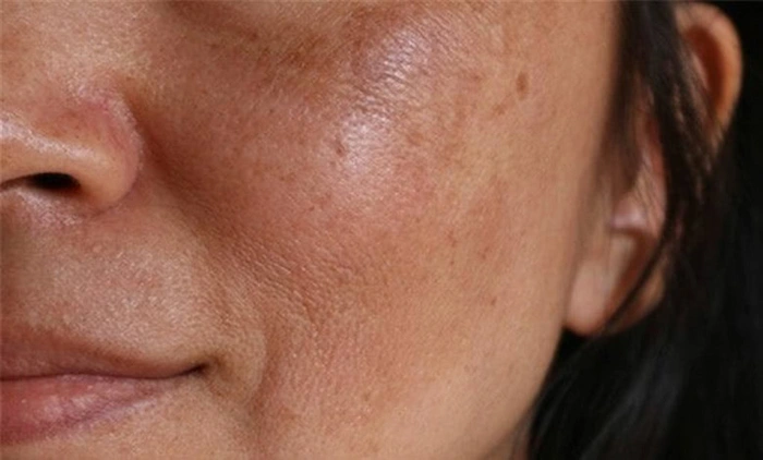 تیره شدن پوست 44476584758