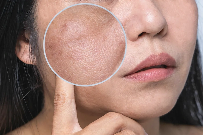 تیره شدن پوست زن 41685496841