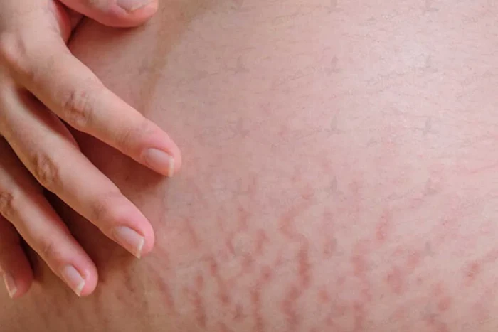 خارش و قرمزی پوست در بارداری 6545420