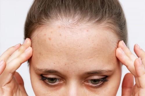 نوع جوش پیشونی 4534545