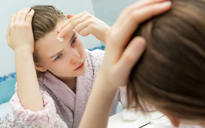 استفاده از لوسیون برای جوش پیشانی 5634534534