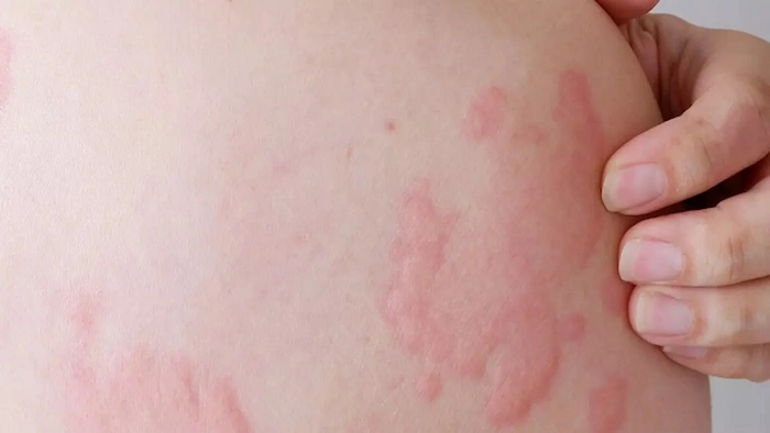 حساسیت پوست بدن و تورم و قرمزی 54564761