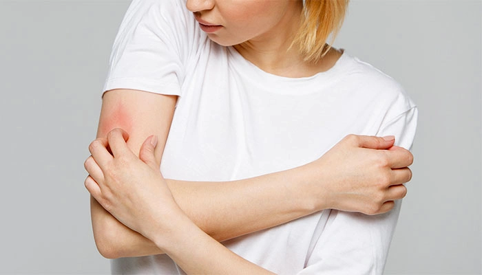 قرمزی و خارش پوست بازو 65464