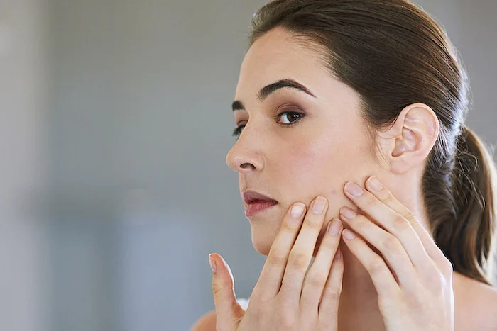 آکنه و جوش بعد از آبرسان 546541