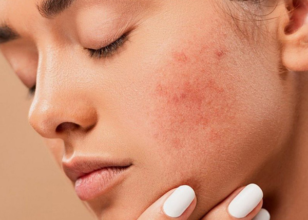 پوست مستعد جوش 544576354678