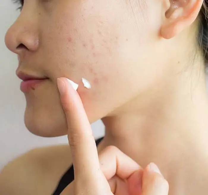 استفاده از کرم ابرسان روی پوست چرب و آکنه دار 656456435