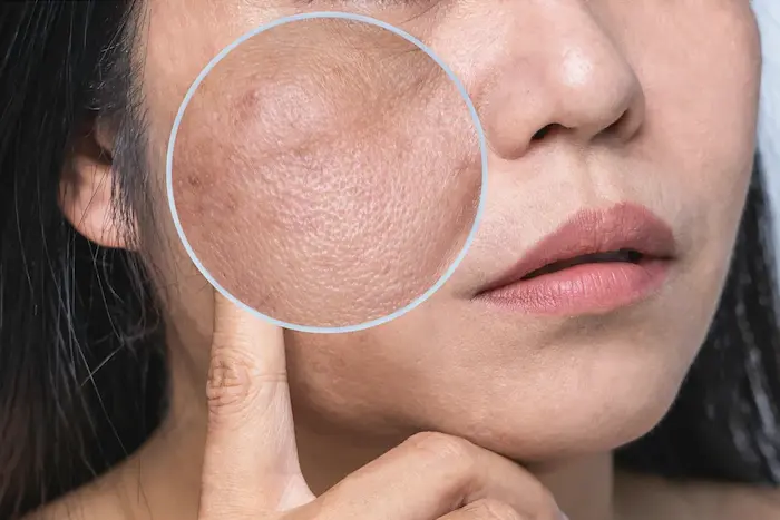 تیره شدن قسمتی از پوست 63634534534