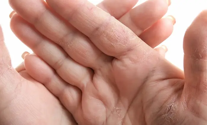 پوسته پوسته شدن پوست کف دست 3415645610