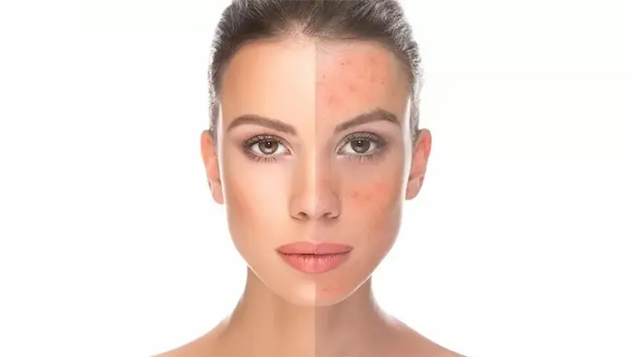 تغییر و درمان تیرگی صورت 564543534