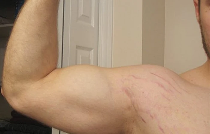 ترک های روی پوست بازو 4564641