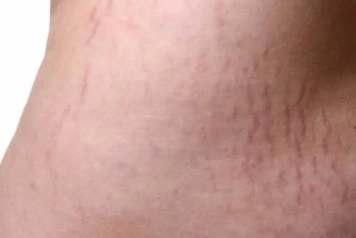 نقش لوسیون بدن در کمرنگ شدن ترک های پوستی 3541545641