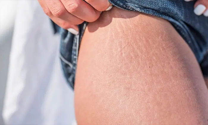 ترک های ران 545641