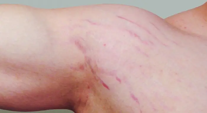 ترک های صورتی در بازو 6456541