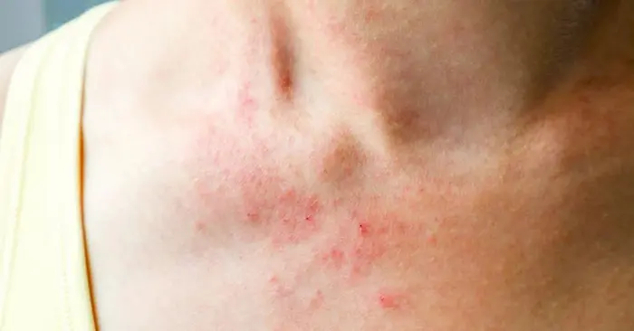 سوزش و قرمزی پوست گردن 345465