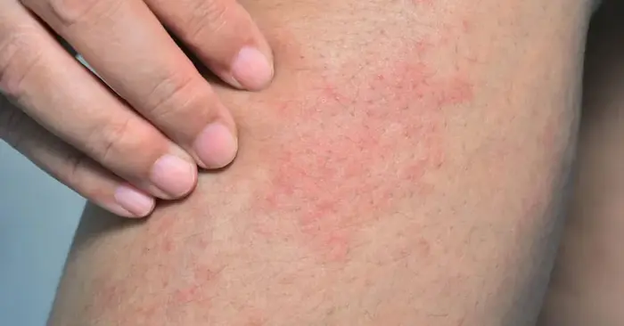 سوزش و قرمزی پوست بدن بعد از استخر 56456462