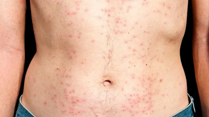 قرمزی پوست بعد از شنا 54564654