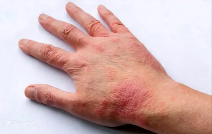 قرمزی و خشکی پوست دست 654684321