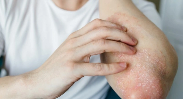 قرمزی و خارش پوستی ناشی از لوپوس 565443