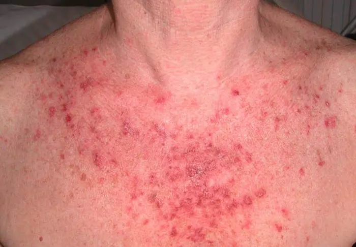 دانه های قرمز پوستی در ناحیه گردن 5456463