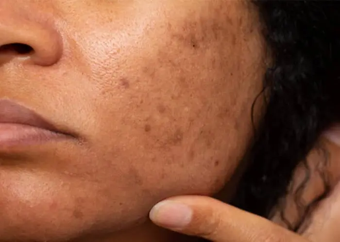 ایجاد لک‌ های پوستی بعد از یائسگی 5456456