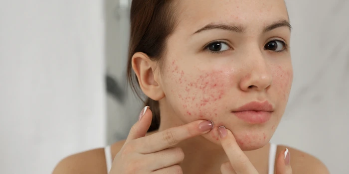 دست زده به التهاب پوستی در نوجوانان 545564560