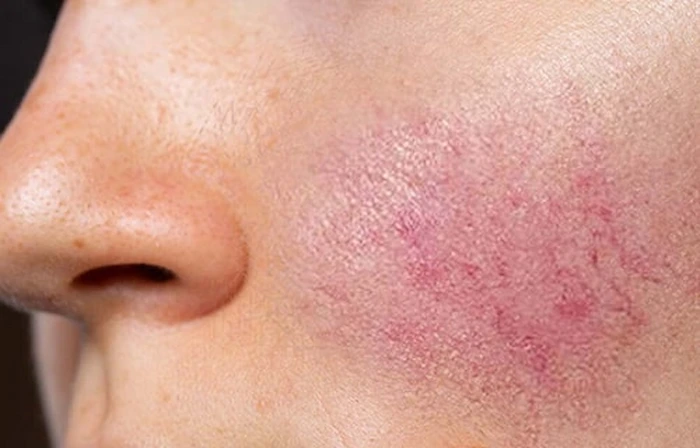 خشکی و قرمزی روی گونه 455645660