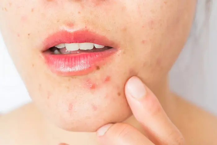 جوش قاعدگی روی چانه 545456450