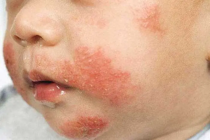 درماتیت سبوره روی صورت نوزادان 68665454