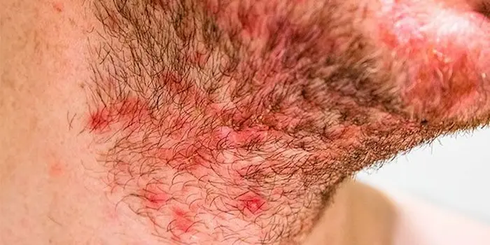 علائم درماتیت سبوره روی چانه صورت66666