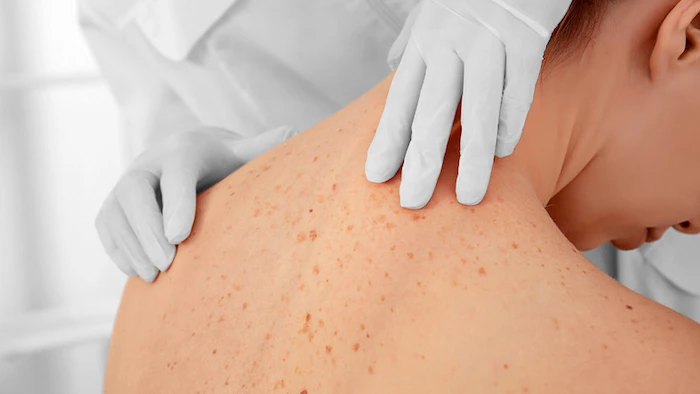 بررسی کورک پوستی یا دمل روی بدن 4655530